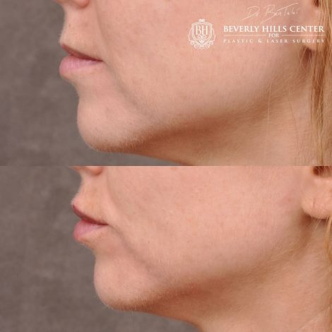 Beverly Hills Center Female Patient Before and After Lip Augmentation using Restylane