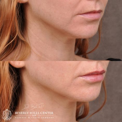 Beverly Hills Center Female Patient Before and After Lip Augmentation using Restylane