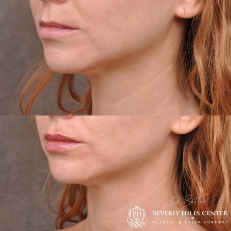 Beverly Hills Center Female Patient Before and After Lip Augmentation using Restylane