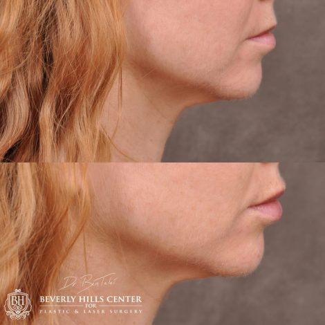 Beverly Hills Center Female Patient Before and After Lip Augmentation using Restylane