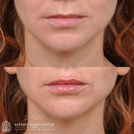 Beverly Hills Center Female Patient Before and After Lip Augmentation using Restylane