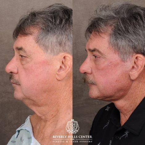 Beverly Hills Center Male Patient Before and After AuraLyft™, Temporal Brow Reset, Upper Blepahroplasty, Fat Grafting