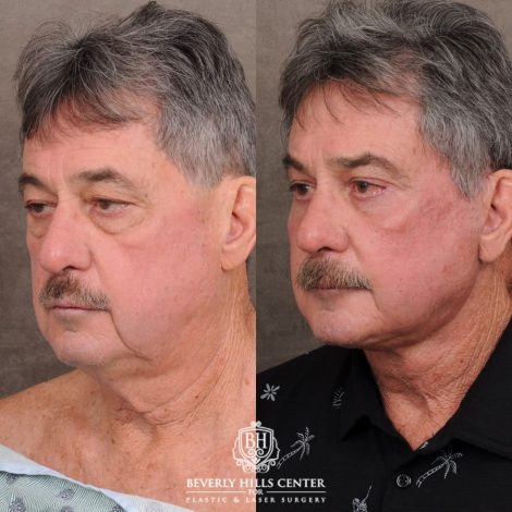 Beverly Hills Center Male Patient Before and After AuraLyft™, Temporal Brow Reset, Upper Blepahroplasty, Fat Grafting