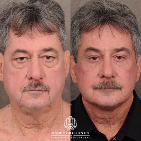 Beverly Hills Center Male Patient Before and After AuraLyft™, Temporal Brow Reset, Upper Blepahroplasty, Fat Grafting