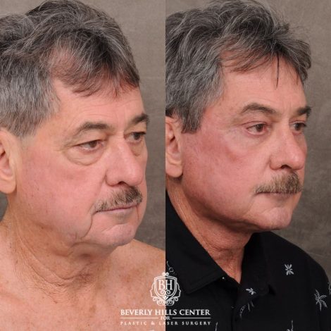 Beverly Hills Center Male Patient Before and After AuraLyft™, Temporal Brow Reset, Upper Blepahroplasty, Fat Grafting