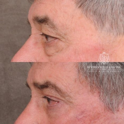 Beverly Hills Center Male Patient Before and After AuraLyft™, Temporal Brow Reset, Upper Blepahroplasty, Fat Grafting
