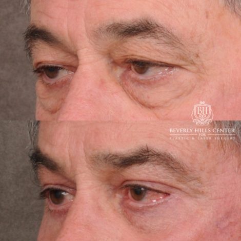 Beverly Hills Center Male Patient Before and After AuraLyft™, Temporal Brow Reset, Upper Blepahroplasty, Fat Grafting