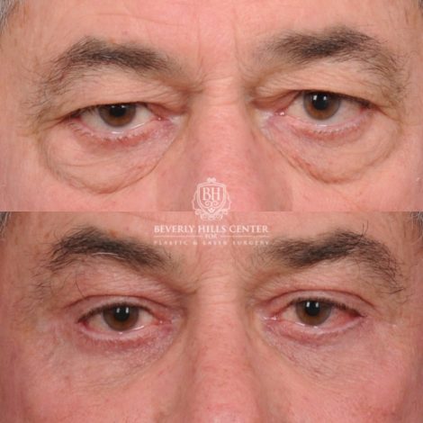Beverly Hills Center Male Patient Before and After AuraLyft™, Temporal Brow Reset, Upper Blepahroplasty, Fat Grafting