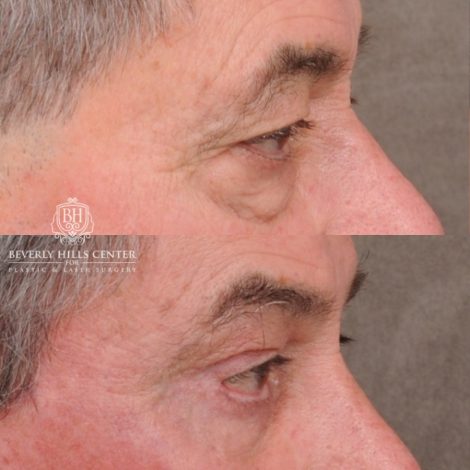 Beverly Hills Center Male Patient Before and After AuraLyft™, Temporal Brow Reset, Upper Blepahroplasty, Fat Grafting