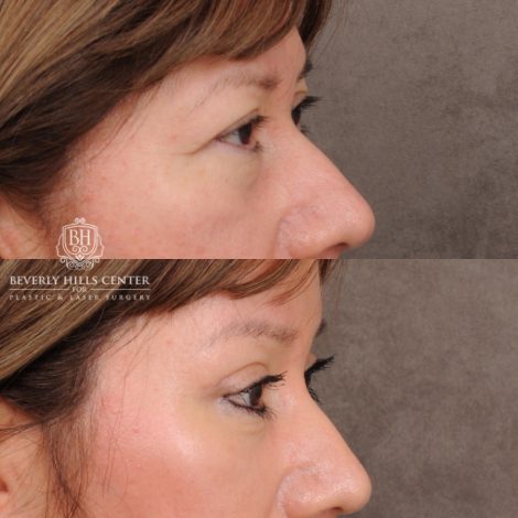 Beverly Hills Center Female Patient Before and After Temporal Brow Reset & Lower Blepharoplasty