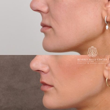 Beverly Hills Center Female Patient Before and After Cupid Lift®