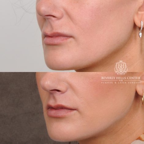 Beverly Hills Center Female Patient Before and After Cupid Lift®