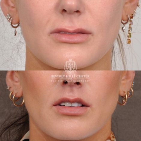 Beverly Hills Center Female Patient Before and After Cupid Lift®