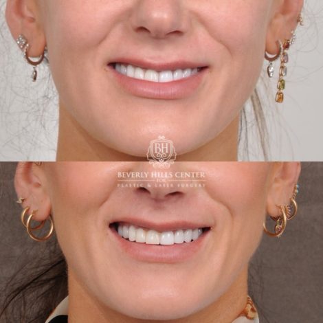 Beverly Hills Center Female Patient Before and After Cupid Lift®