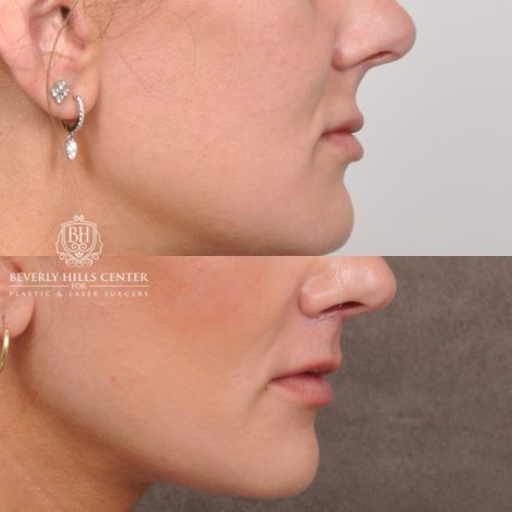 Beverly Hills Center Female Patient Before and After Cupid Lift®