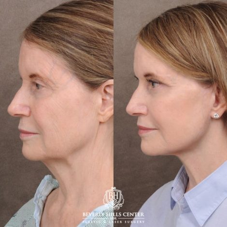 Beverly Hills Center Female Patient Before and After AuraLyft™, Cupid Lift®, Temporal Brow Reset, Ptosis Repair, Fat grafting