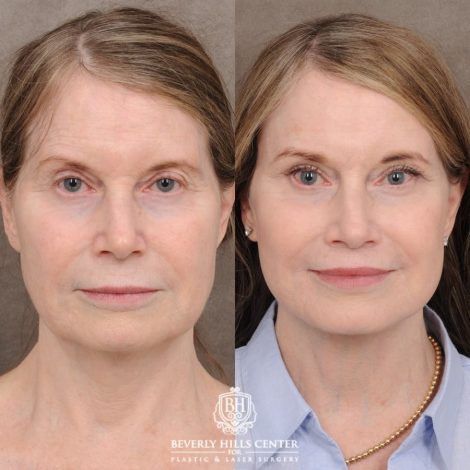 Beverly Hills Center Female Patient Before and After AuraLyft™, Cupid Lift®, Temporal Brow Reset, Ptosis Repair, Fat grafting