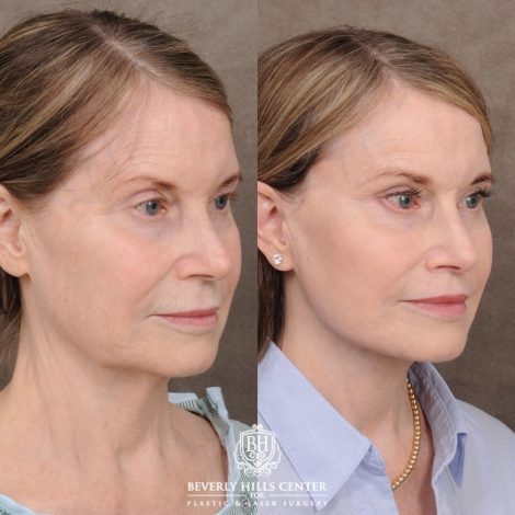 Beverly Hills Center Female Patient Before and After AuraLyft™, Cupid Lift®, Temporal Brow Reset, Ptosis Repair, Fat grafting