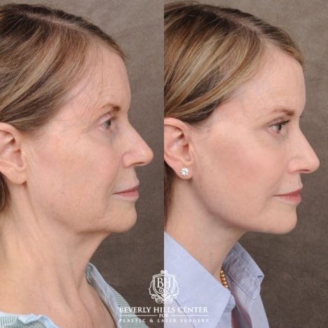 Beverly Hills Center Female Patient Before and After AuraLyft™, Cupid Lift®, Temporal Brow Reset, Ptosis Repair, Fat grafting