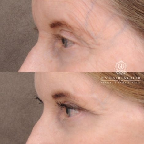 Beverly Hills Center Female Patient Before and After AuraLyft™, Cupid Lift®, Temporal Brow Reset, Ptosis Repair, Fat grafting