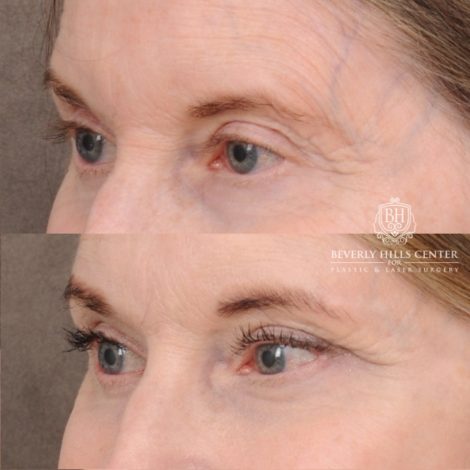 Beverly Hills Center Female Patient Before and After AuraLyft™, Cupid Lift®, Temporal Brow Reset, Ptosis Repair, Fat grafting