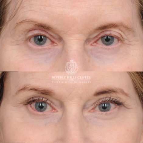 Beverly Hills Center Female Patient Before and After AuraLyft™, Cupid Lift®, Temporal Brow Reset, Ptosis Repair, Fat grafting