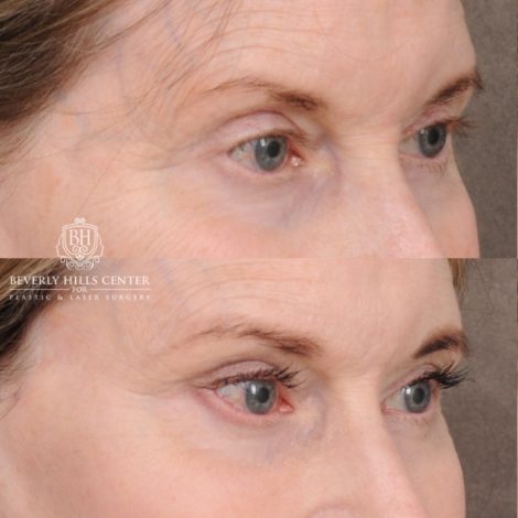 Beverly Hills Center Female Patient Before and After AuraLyft™, Cupid Lift®, Temporal Brow Reset, Ptosis Repair, Fat grafting