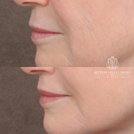 Beverly Hills Center Female Patient Before and After AuraLyft™, Cupid Lift®, Temporal Brow Reset, Ptosis Repair, Fat grafting