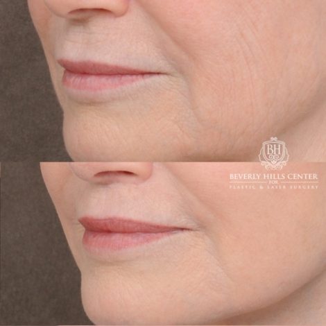 Beverly Hills Center Female Patient Before and After AuraLyft™, Cupid Lift®, Temporal Brow Reset, Ptosis Repair, Fat grafting