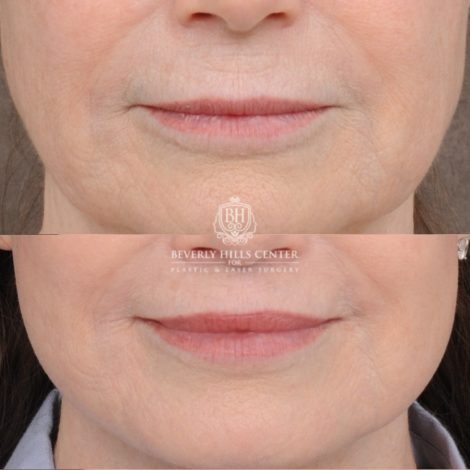 Beverly Hills Center Female Patient Before and After AuraLyft™, Cupid Lift®, Temporal Brow Reset, Ptosis Repair, Fat grafting