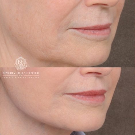Beverly Hills Center Female Patient Before and After AuraLyft™, Cupid Lift®, Temporal Brow Reset, Ptosis Repair, Fat grafting