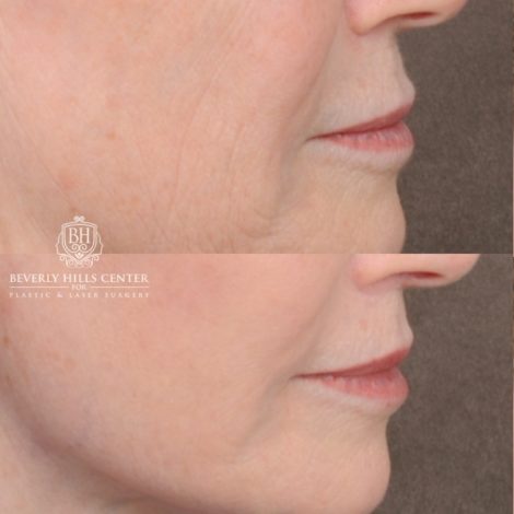 Beverly Hills Center Female Patient Before and After AuraLyft™, Cupid Lift®, Temporal Brow Reset, Ptosis Repair, Fat grafting