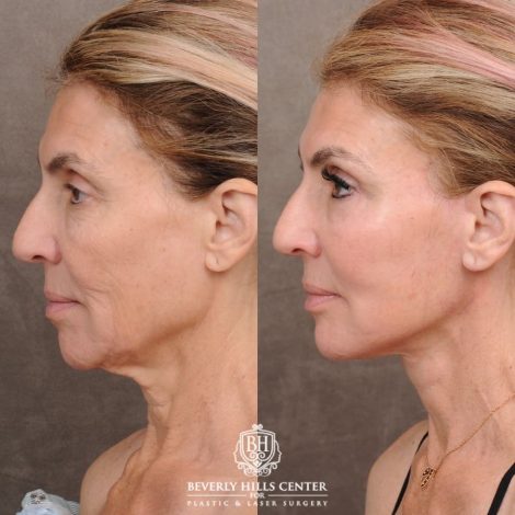 Beverly Hills Center Female Patient Before and After AuraLyft™, Temporal Brow Reset, Upper & Lower Blepharoplasty, Ptosis Repair, Fat grafting