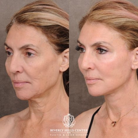 Beverly Hills Center Female Patient Before and After AuraLyft™, Temporal Brow Reset, Upper & Lower Blepharoplasty, Ptosis Repair, Fat grafting