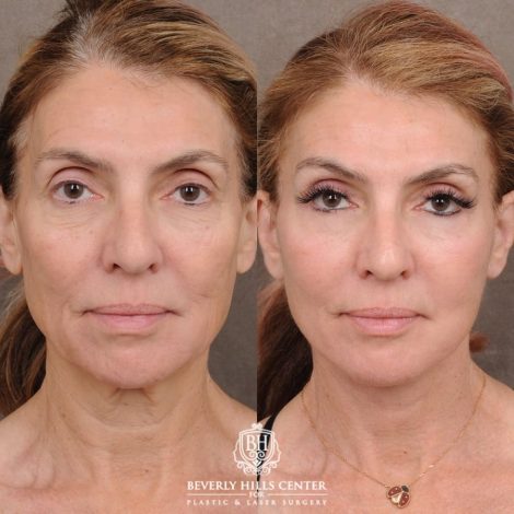 Beverly Hills Center Female Patient Before and After AuraLyft™, Temporal Brow Reset, Upper & Lower Blepharoplasty, Ptosis Repair, Fat grafting