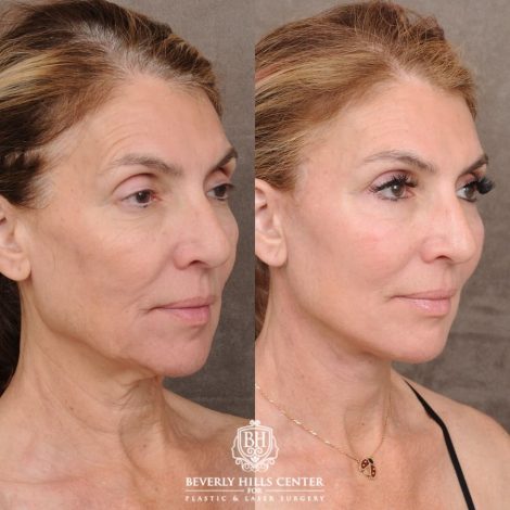Beverly Hills Center Female Patient Before and After AuraLyft™, Temporal Brow Reset, Upper & Lower Blepharoplasty, Ptosis Repair, Fat grafting