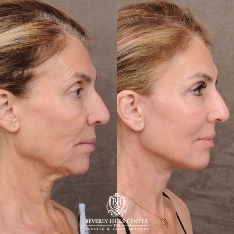 Beverly Hills Center Female Patient Before and After AuraLyft™, Temporal Brow Reset, Upper & Lower Blepharoplasty, Ptosis Repair, Fat grafting