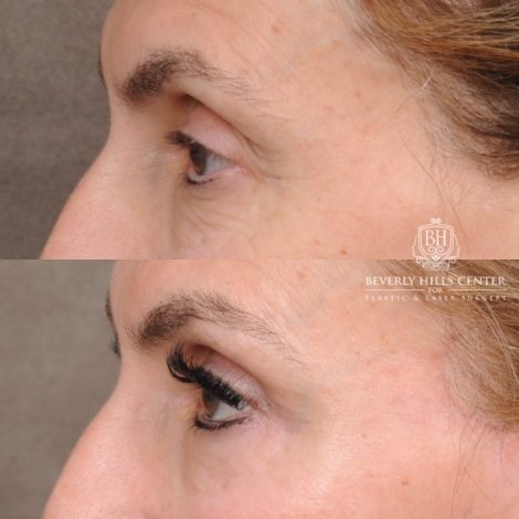 Beverly Hills Center Female Patient Before and After AuraLyft™, Temporal Brow Reset, Upper & Lower Blepharoplasty, Ptosis Repair, Fat grafting
