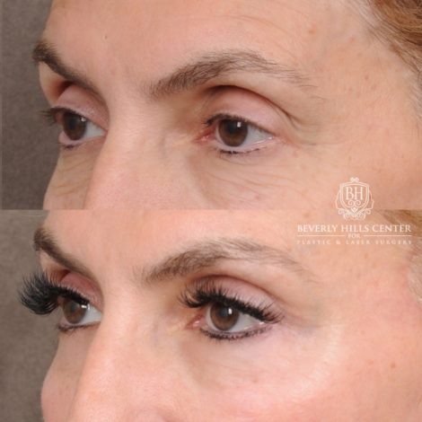 Beverly Hills Center Female Patient Before and After AuraLyft™, Temporal Brow Reset, Upper & Lower Blepharoplasty, Ptosis Repair, Fat grafting