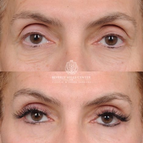 Beverly Hills Center Female Patient Before and After AuraLyft™, Temporal Brow Reset, Upper & Lower Blepharoplasty, Ptosis Repair, Fat grafting