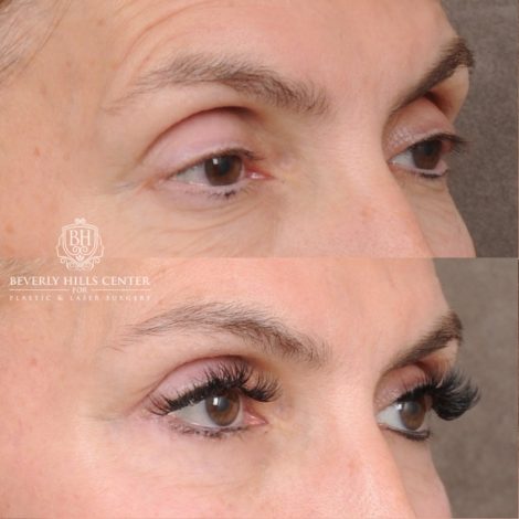 Beverly Hills Center Female Patient Before and After AuraLyft™, Temporal Brow Reset, Upper & Lower Blepharoplasty, Ptosis Repair, Fat grafting