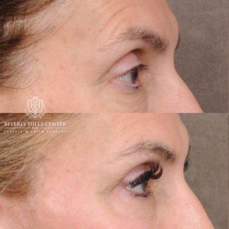 Beverly Hills Center Female Patient Before and After AuraLyft™, Temporal Brow Reset, Upper & Lower Blepharoplasty, Ptosis Repair, Fat grafting