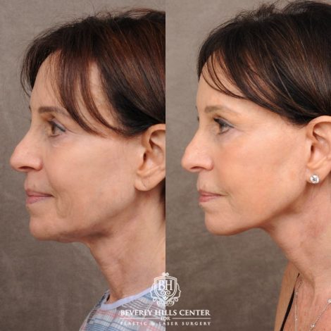 Beverly Hills Center Female Patient Before and After AuraLyft™, Temporal Brow Reset, and Fat Grafting