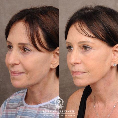 Beverly Hills Center Female Patient Before and After AuraLyft™, Temporal Brow Reset, and Fat Grafting
