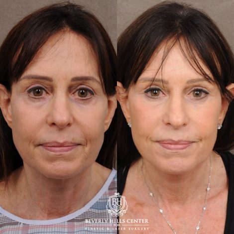 Beverly Hills Center Female Patient Before and After AuraLyft™, Temporal Brow Reset, and Fat Grafting