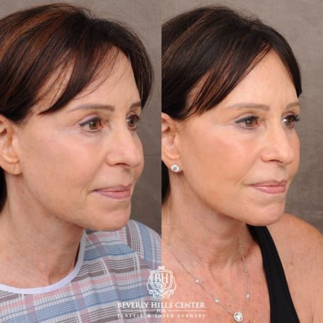Beverly Hills Center Female Patient Before and After AuraLyft™, Temporal Brow Reset, and Fat Grafting