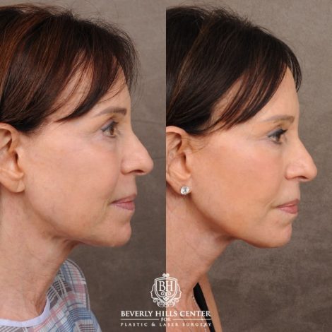 Beverly Hills Center Female Patient Before and After AuraLyft™, Temporal Brow Reset, and Fat Grafting