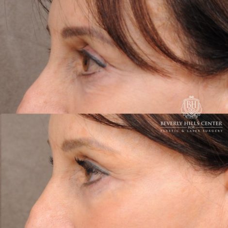Beverly Hills Center Female Patient Before and After AuraLyft™, Temporal Brow Reset, and Fat Grafting