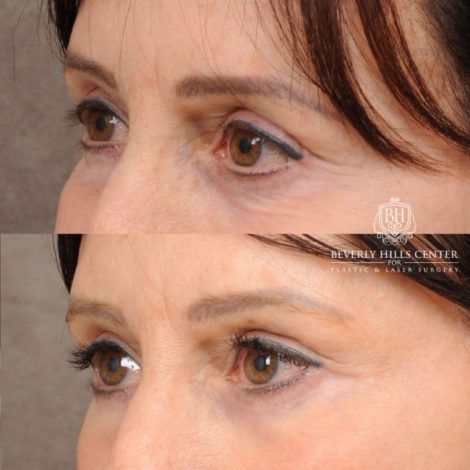 Beverly Hills Center Female Patient Before and After AuraLyft™, Temporal Brow Reset, and Fat Grafting