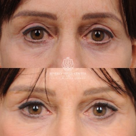 Beverly Hills Center Female Patient Before and After AuraLyft™, Temporal Brow Reset, and Fat Grafting